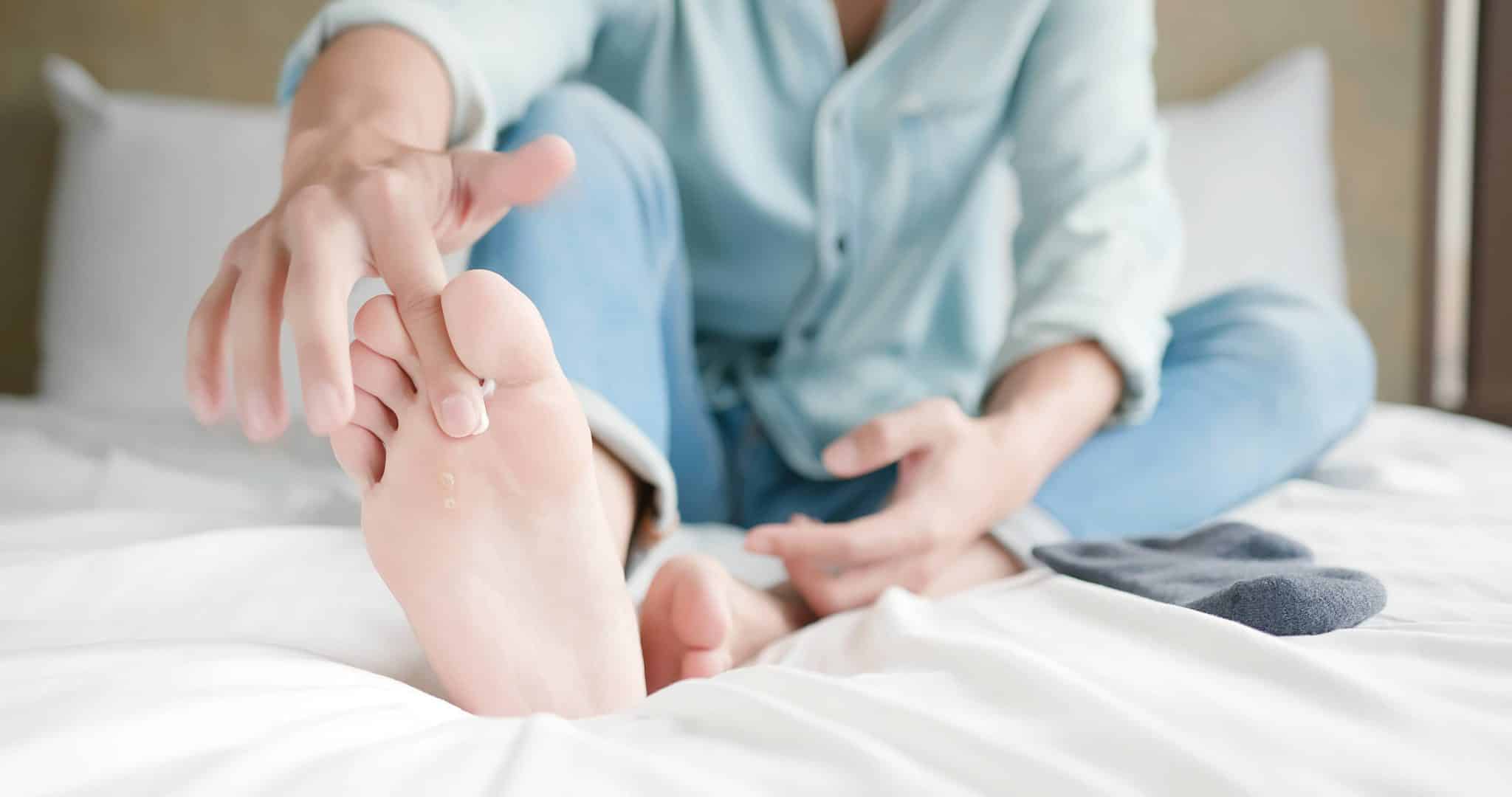 Psoriasis des pieds